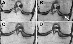 MRIs of the right knee obtained with the coronal proton density–weighted fast spin-echo fat-suppression sequence at, A, C, baseline and, B, D, after 48 months. Patients were an obese 65-year-old woman with stable weight and mild knee pain (A and B) and an