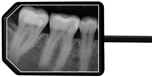 Apex Dental Sensor X-Ray