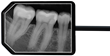 Apex Dental Sensor X-Ray