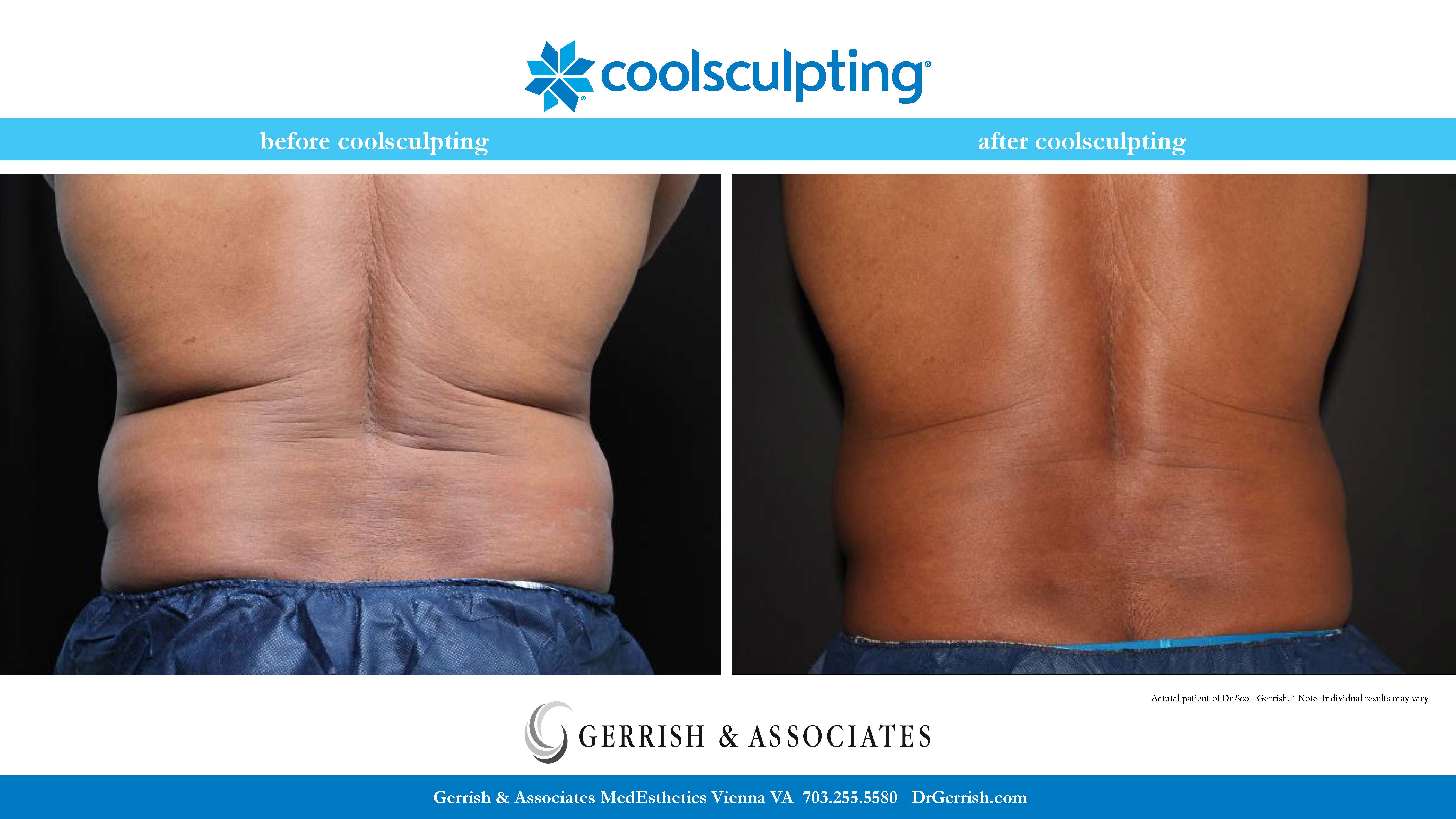 Actual Patient of Dr. Gerrish CoolSculpting Results