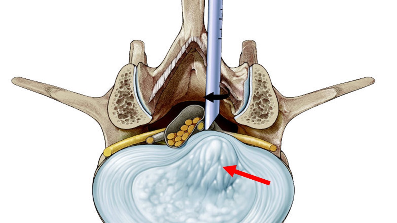 Artist's depiction shows a lumbar endoscopic operation take place via a 8 millimeter tube (black arrow).  The tube is placed over a disc herniation (red arrow).