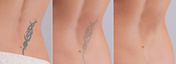 Tattoo Removal Now Offered by Lakes Dermatology