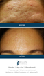 SkinPen Precision Microneedling Before and After