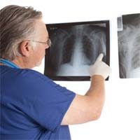 Little Difference Found Between Mesothelioma Surgery Survival