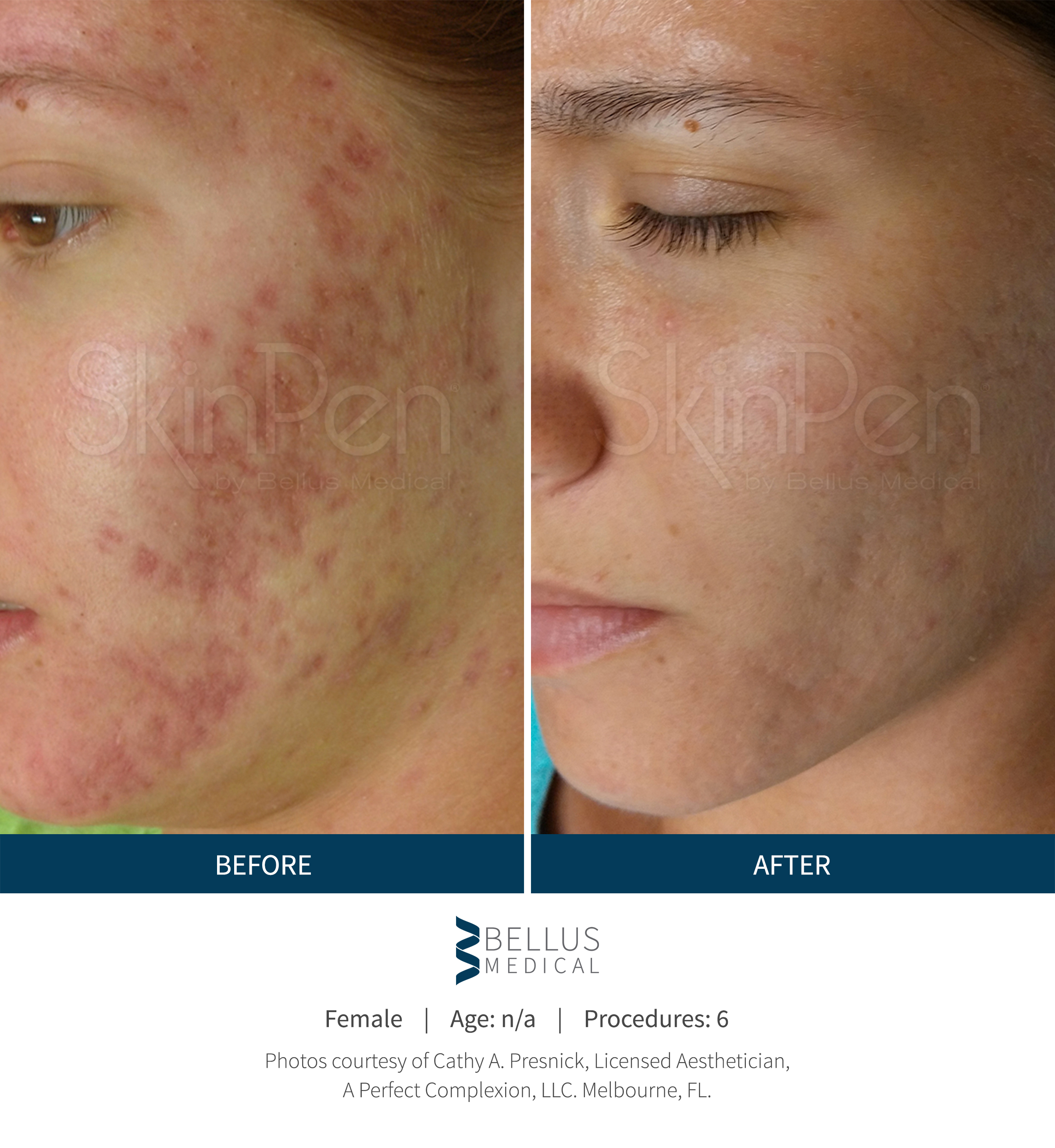 SkinPen Precision Microneedling Before and After for treatment of acne scarring