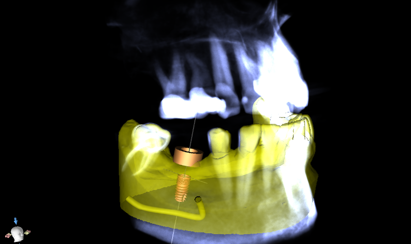 CT Overlay for Implant Planning