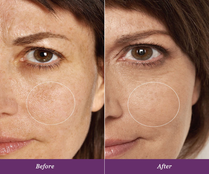Consumers experienced a 44% reduction in the appearance of pores