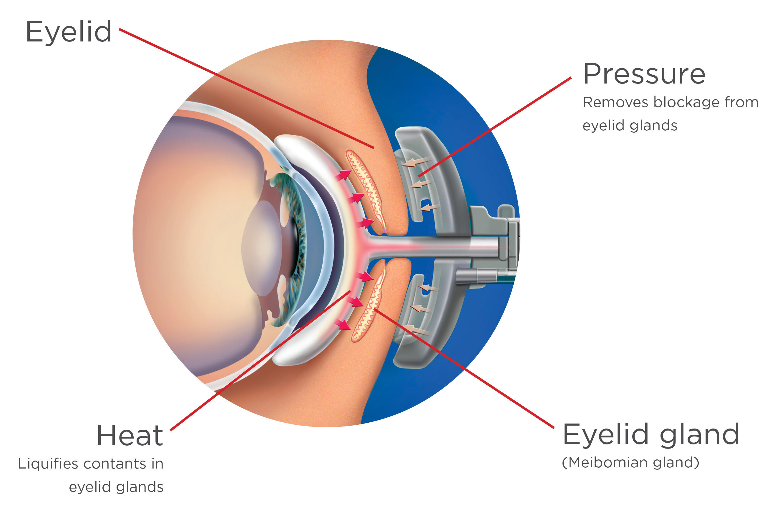 LipiFlow placement and how it works