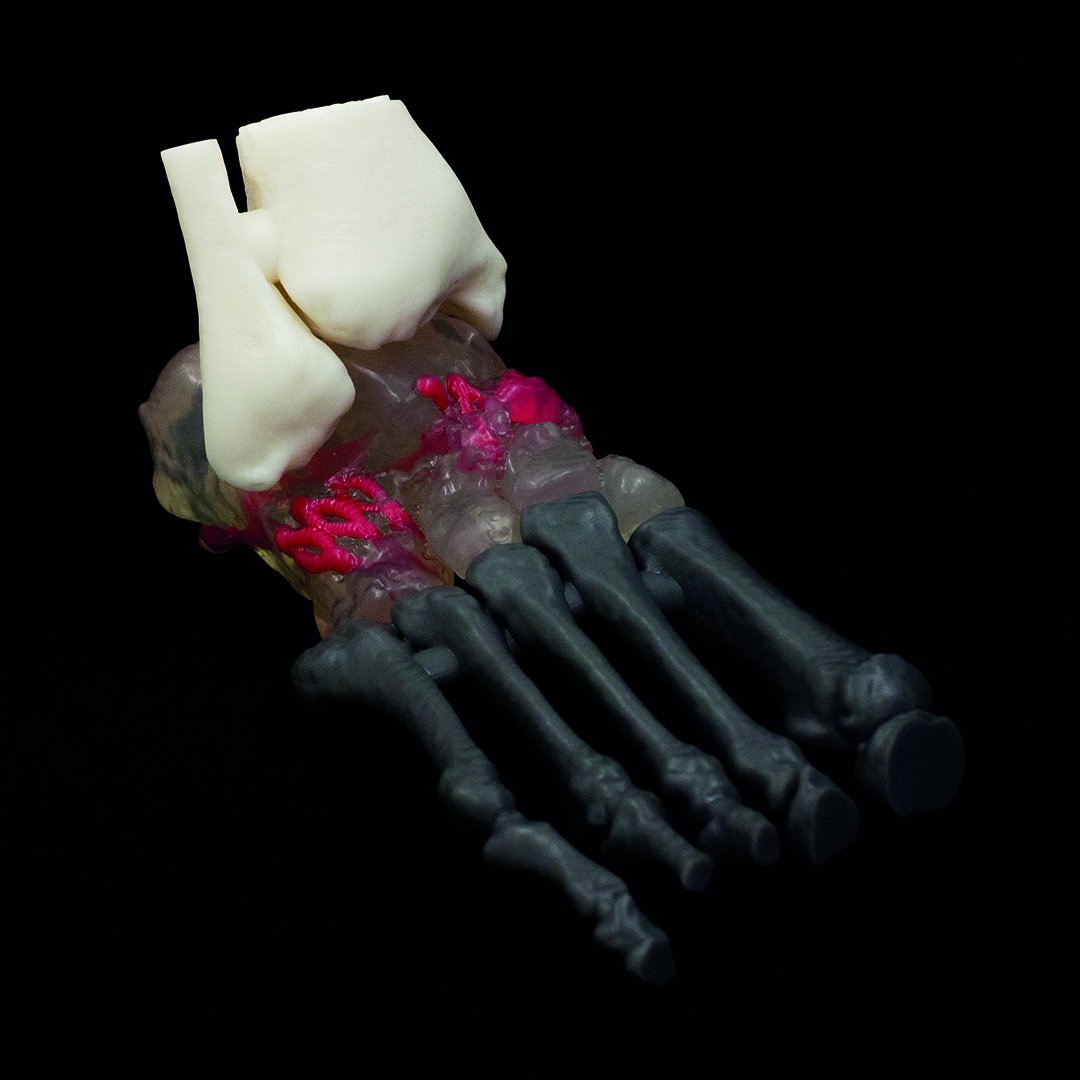 axial3D patient-specific 3D printed model assists in complex orthopaedic surgery planning