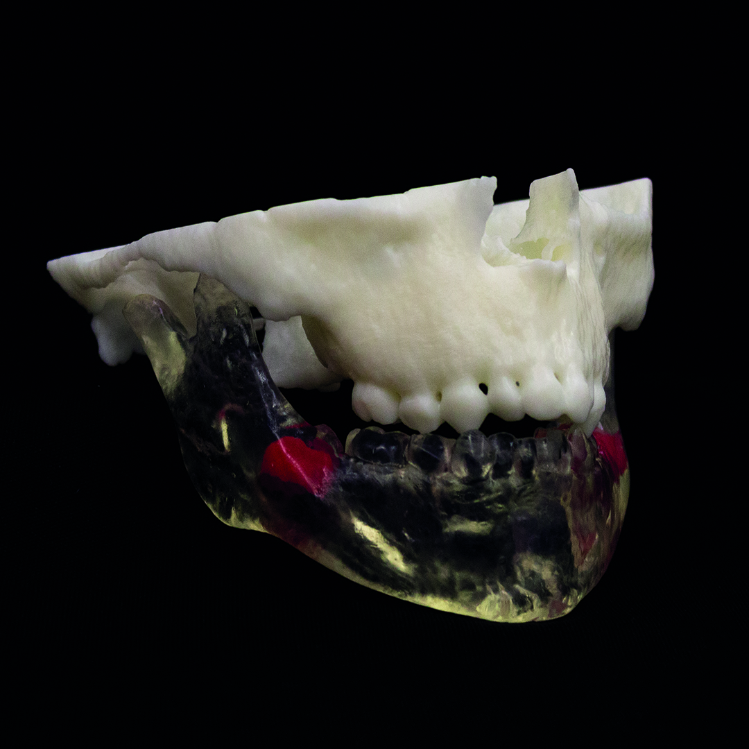 axial3D patient-specific 3D printed model assists in complex maxillofacial surgery planning