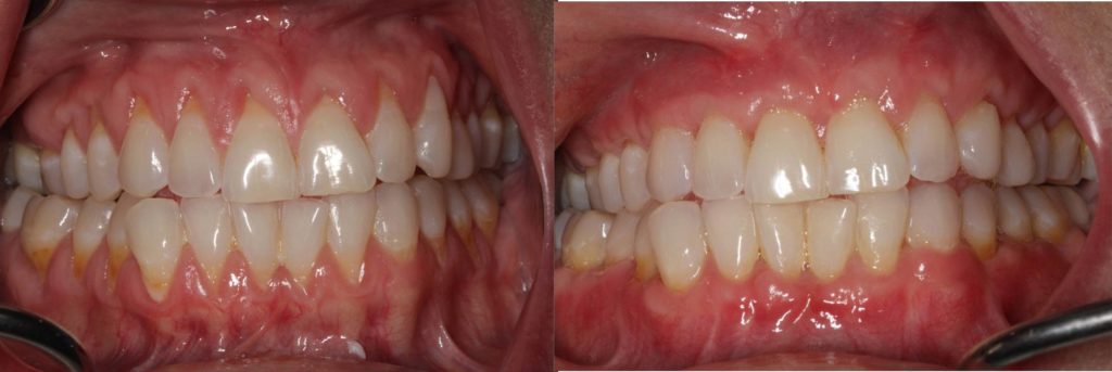 Before (left) and After (right) the patient was treated with the Pinhole Surgical Technique.