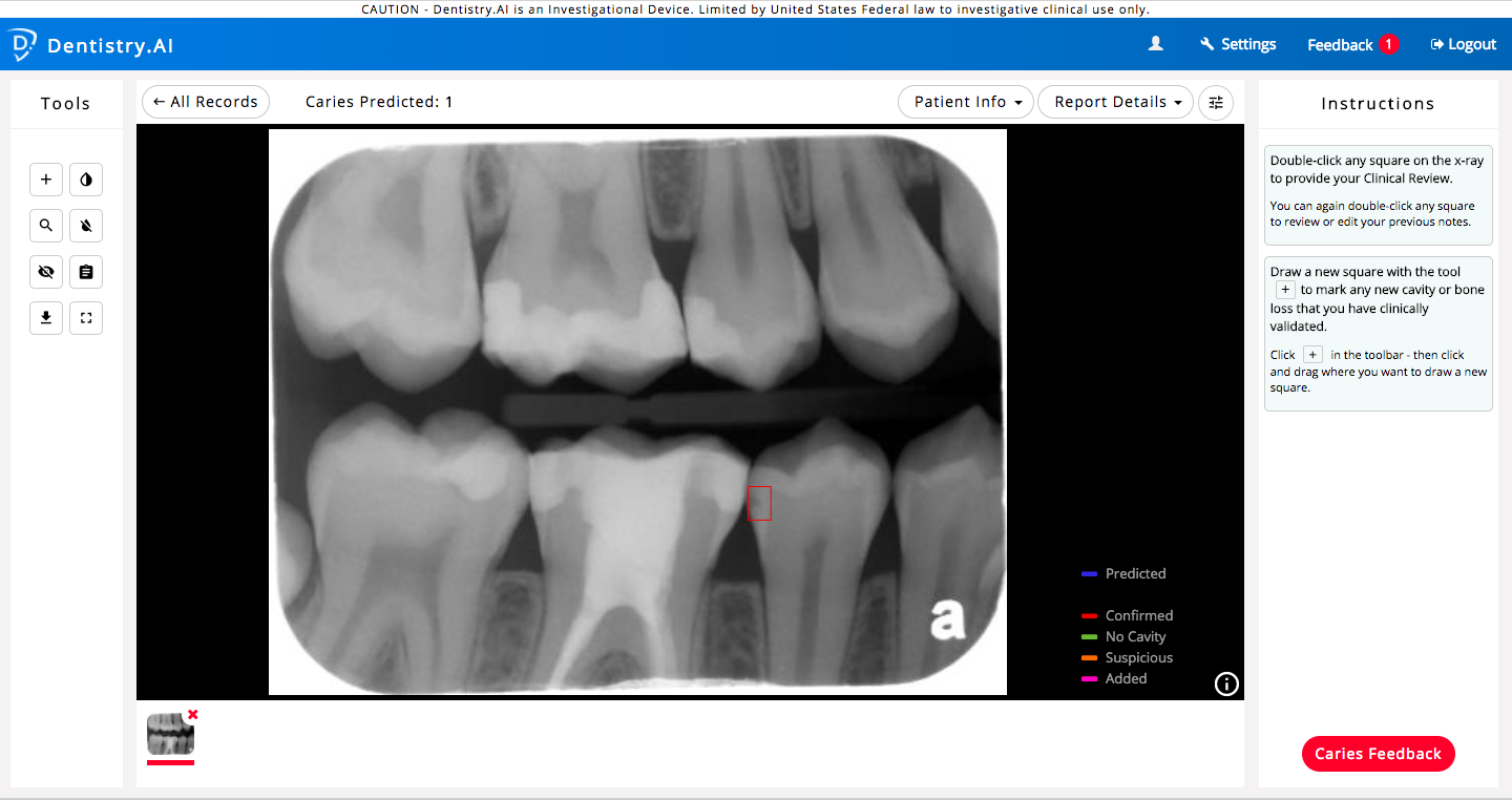 Dentistry.AI helps dentists by instantly highlighting areas on dental x-rays that have a high probability of caries so that dentists can focus on examining these areas more closely.