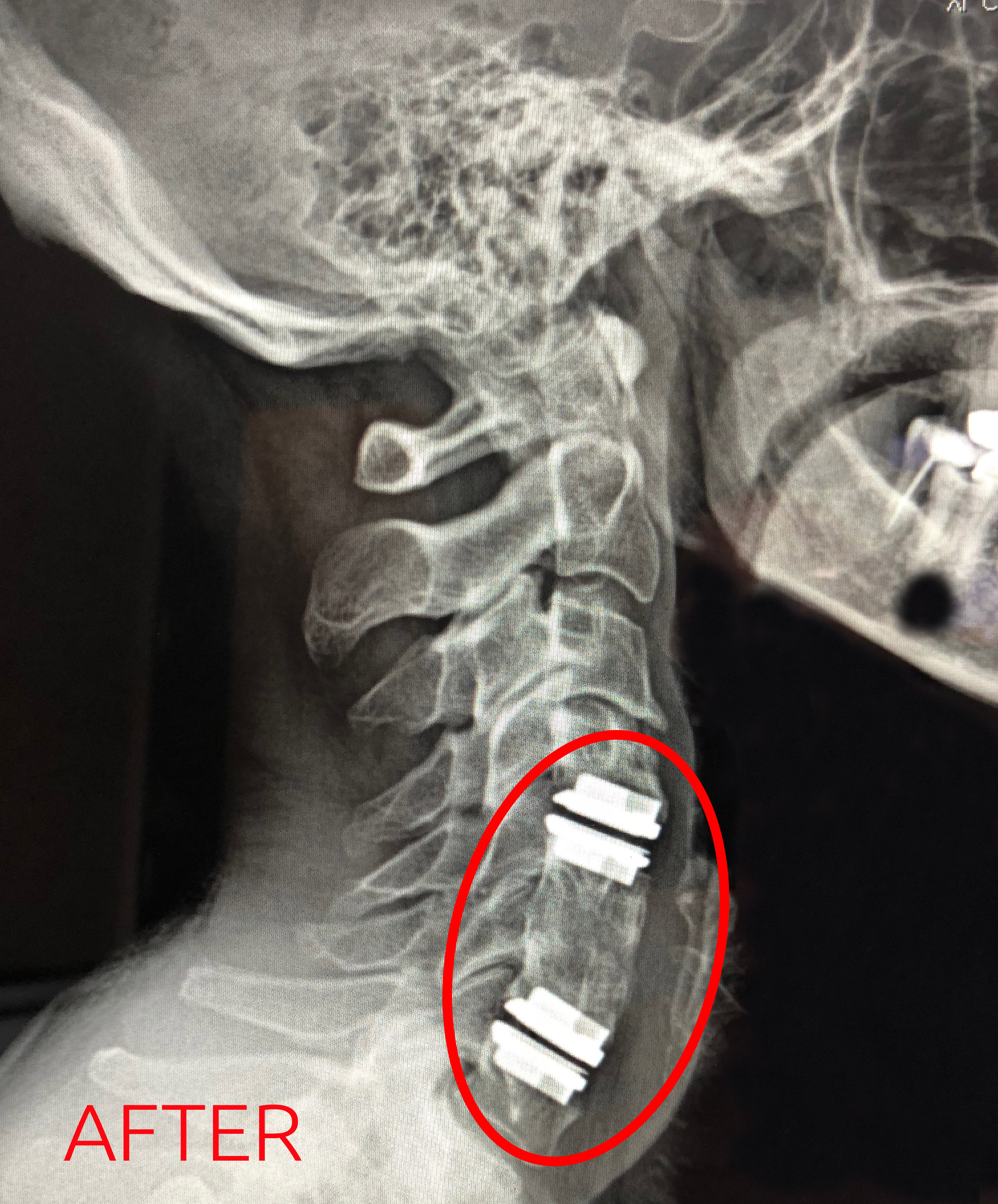 Andrea Leigh Logan's X-Ray After Surgery