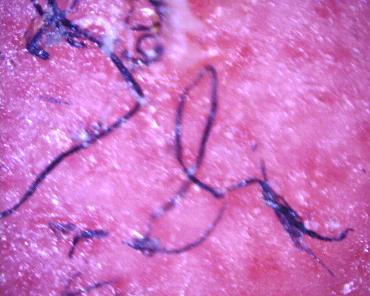 Filaments remain embedded in deeper layers of skin after removal of a callus ( 100X magnification).