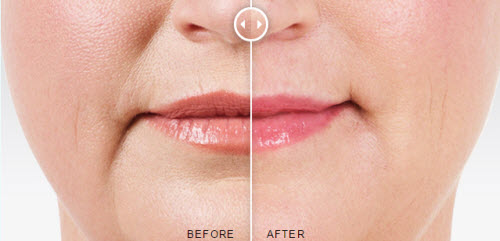 Juvederm Before/After