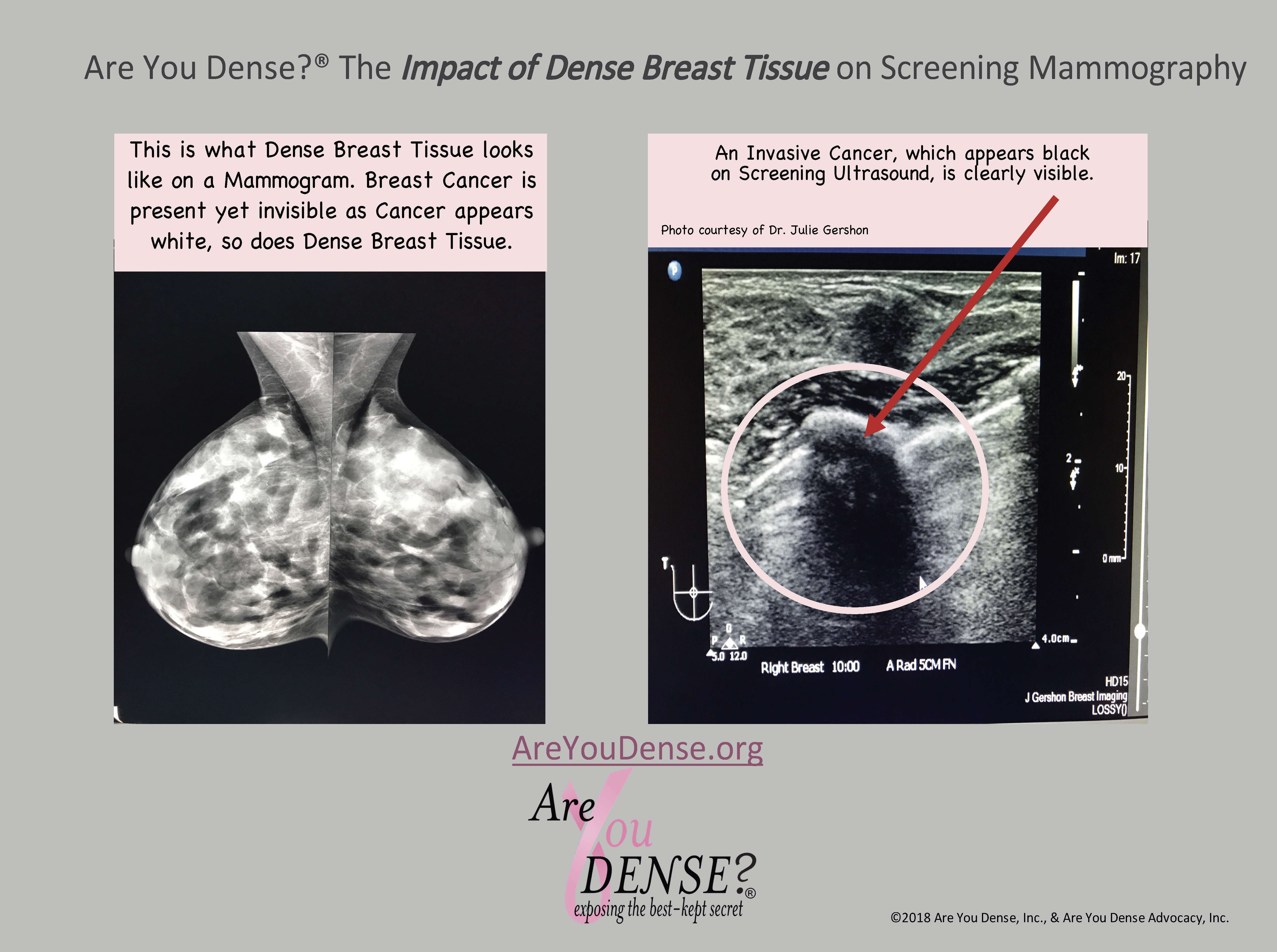 Dense Breasts: The Masking of Cancer on Mammogram