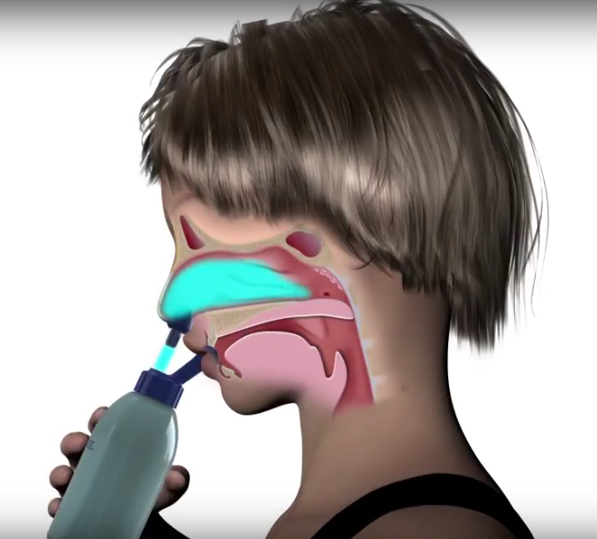 With its innovative Nasal Lock™ technology, ResQRinse directs saline solution to the sinuses — not down the throat.