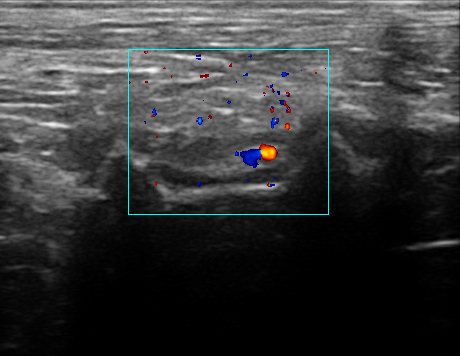 Example in vivo ultrasound image of EchoMark marking vessels in soft tissue.