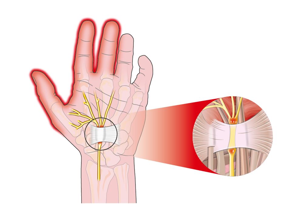 Here is an illustration of the muscles and nerves affected by carpal tunnel syndrome.