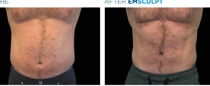 Emsculpt