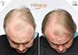 Proof-of-Progress: Before & After Photo of Male Participant using Theragrow.
