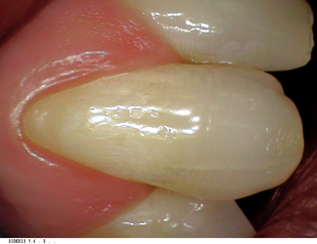 Pinhole Gum Rejuvenation Surgery - Before