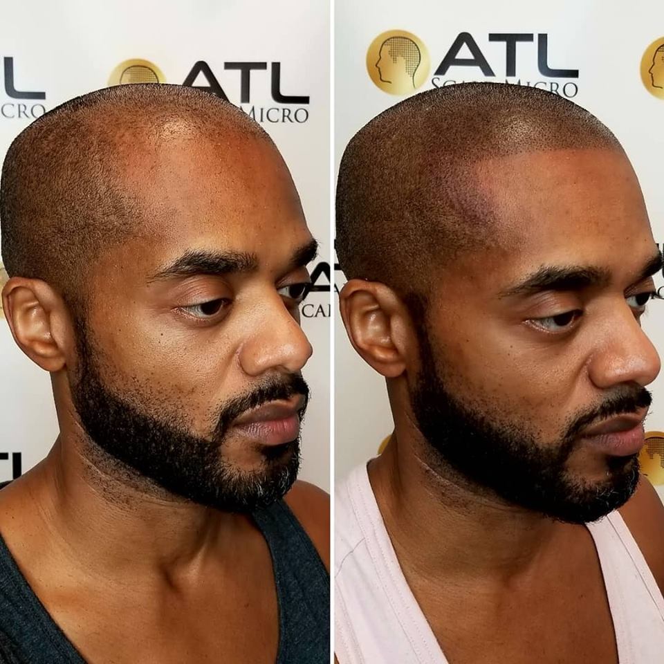 Before and After Scalp Micropigmentation at ATL Scalp Micro