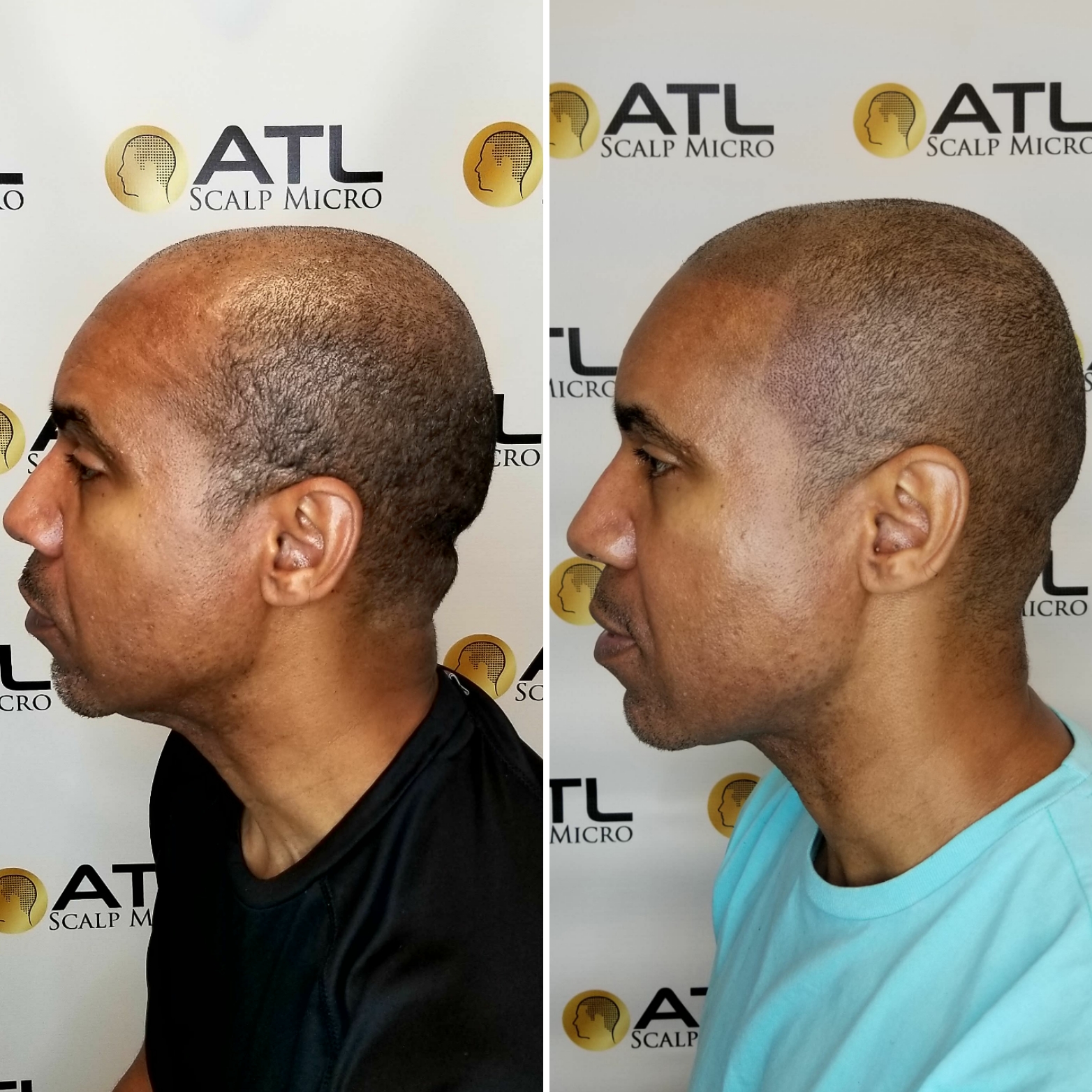 Before and After Scalp Micropigmentation at ATL Scalp Micro