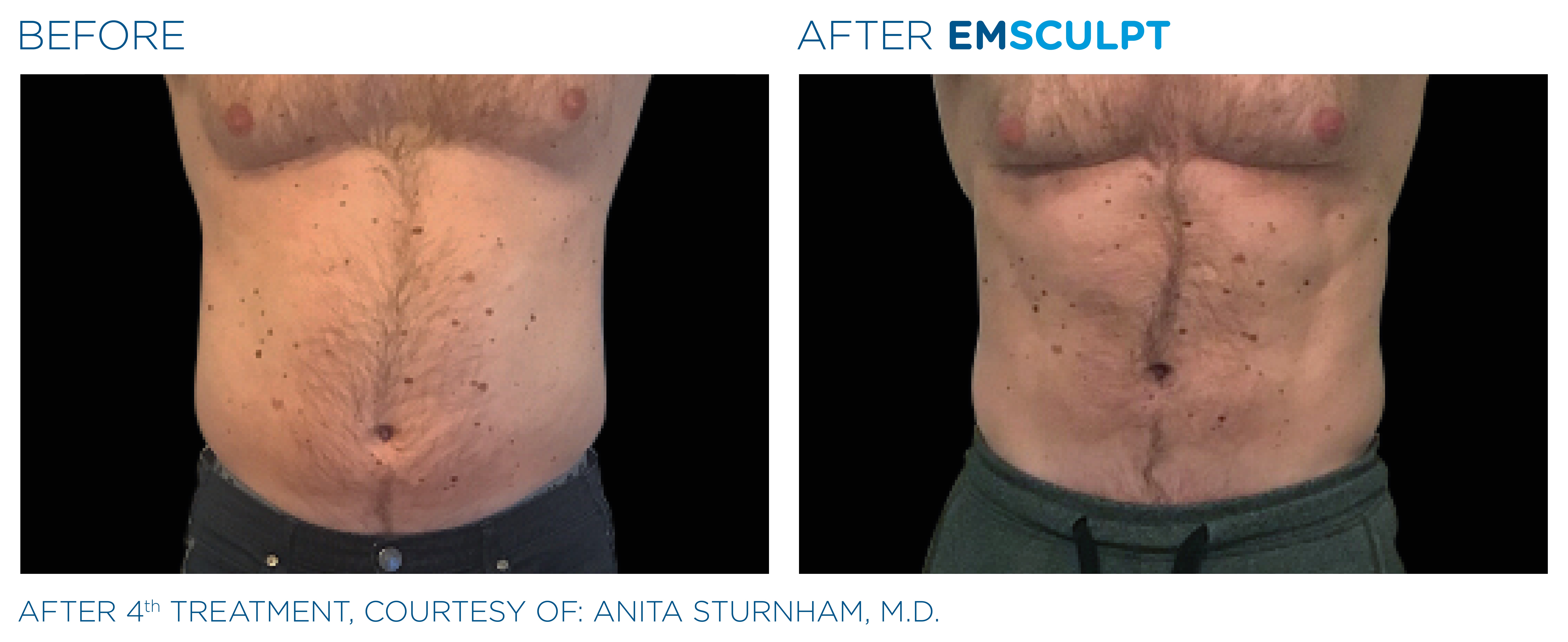 Man Stomach Emsculpt Before and After