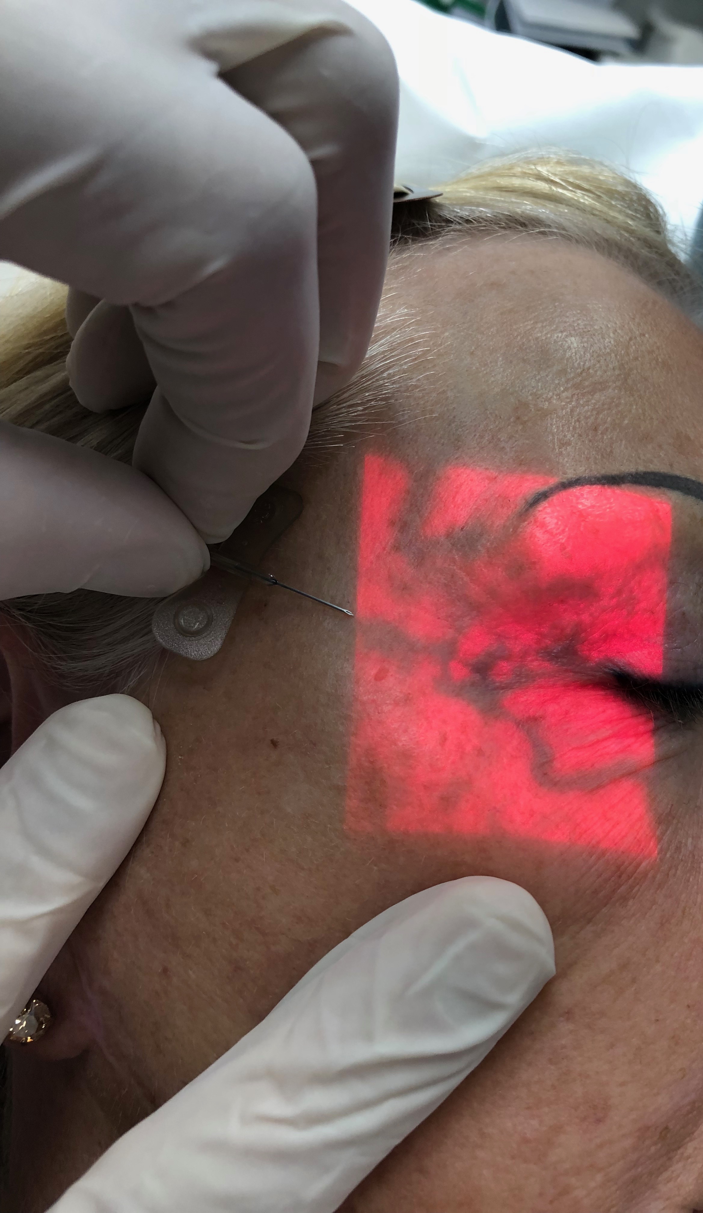 Illumination of Peri Ocular Venous Anatomy