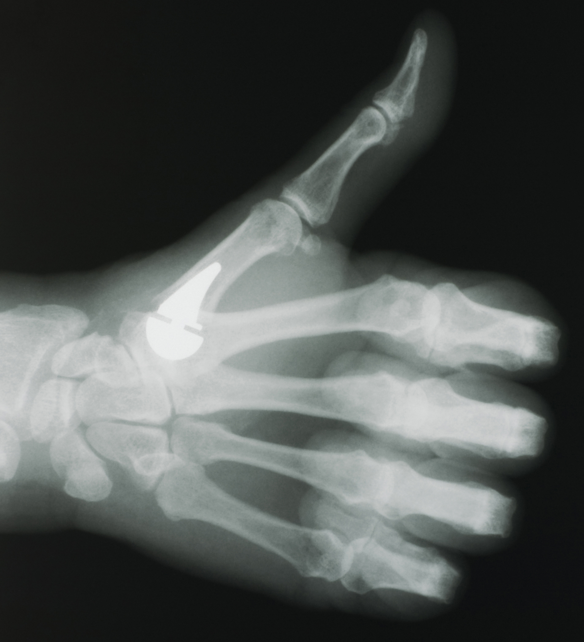 X Ray Left Thumb