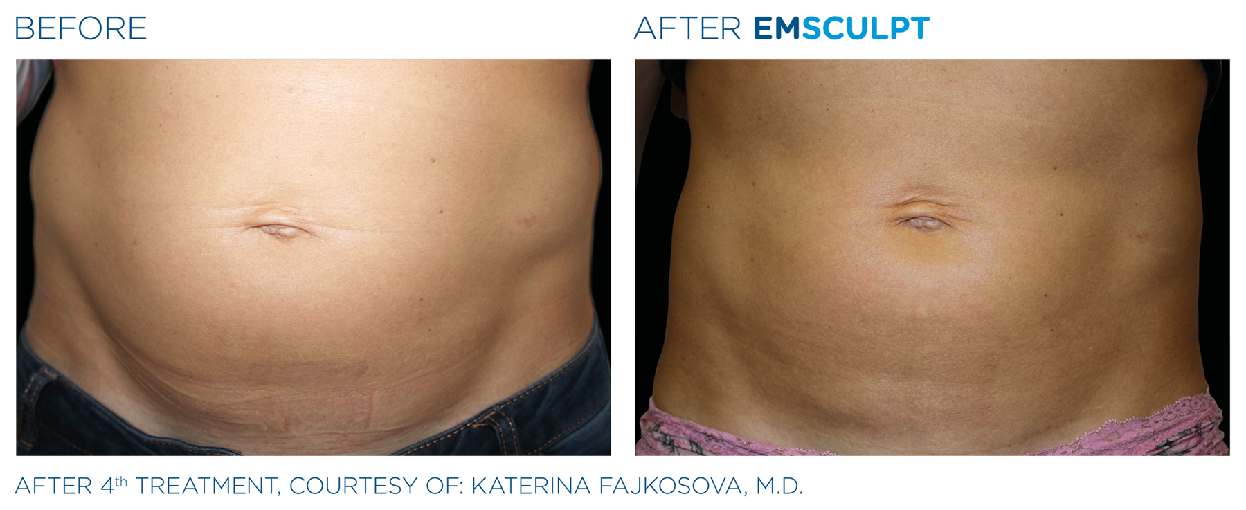 EMSCULPT Body Shaping Before & After Photo