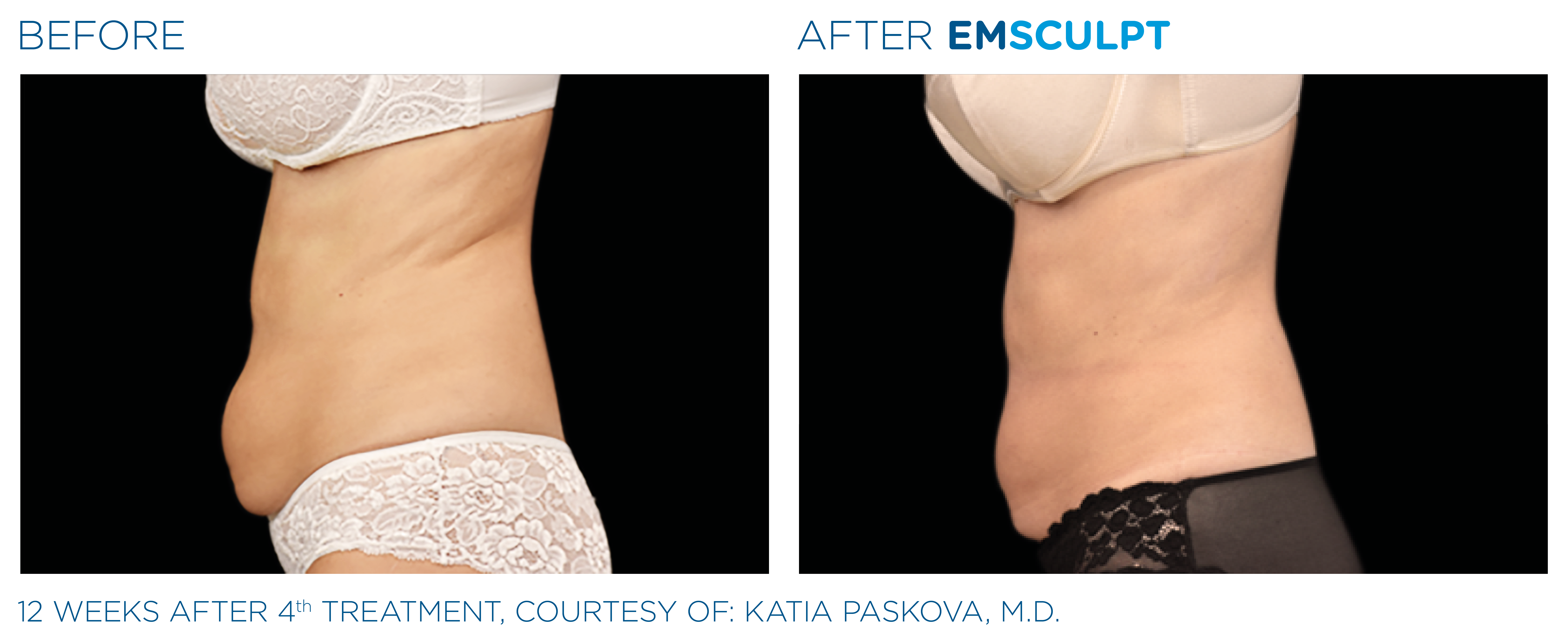 EMSCULPT Body Shaping Before & After Photo