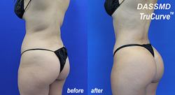Brazilian Butt Lift Surgery in Mumbai: Enhance Your Curves with Dr