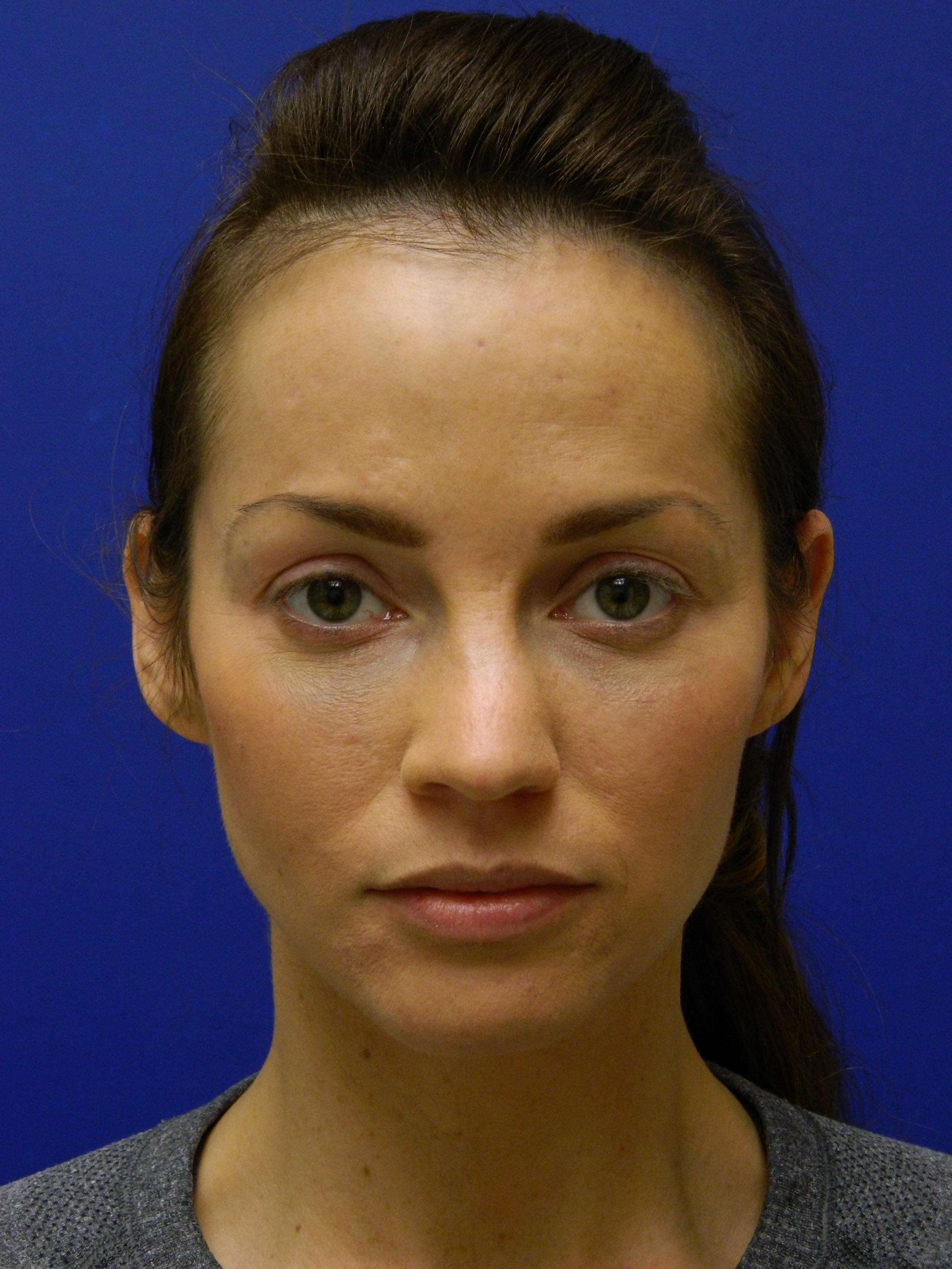 Before and after photos illustrate a stunning transformation by artistic facial plastic surgeon Dr. Paul Stanislaw that achieves a beautifully “natural” no makeup look.