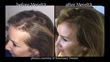Photos of Rosemary Tessier before and after using Mereltä Root Renewal serum.