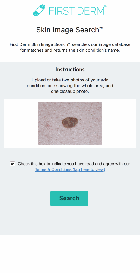 Skin Image Search - First Derm AI - benign mole