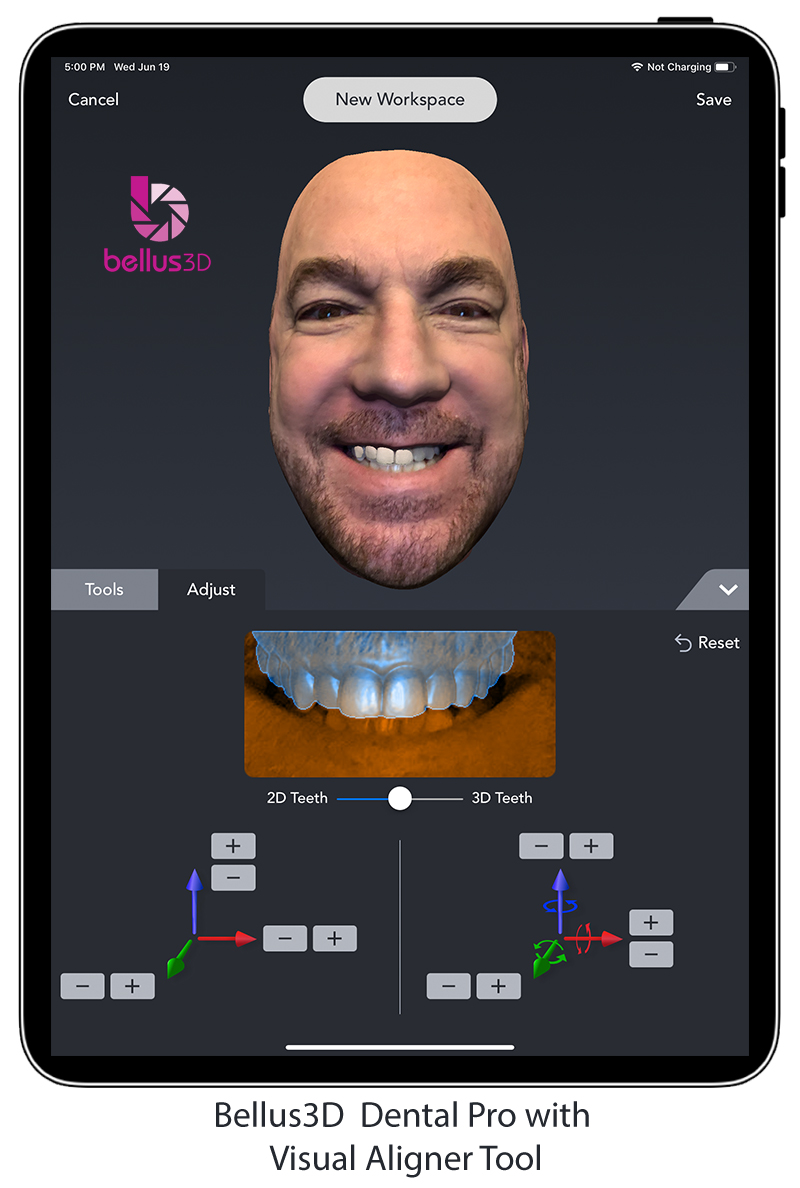 Visual Smile Aligner iPad Pro