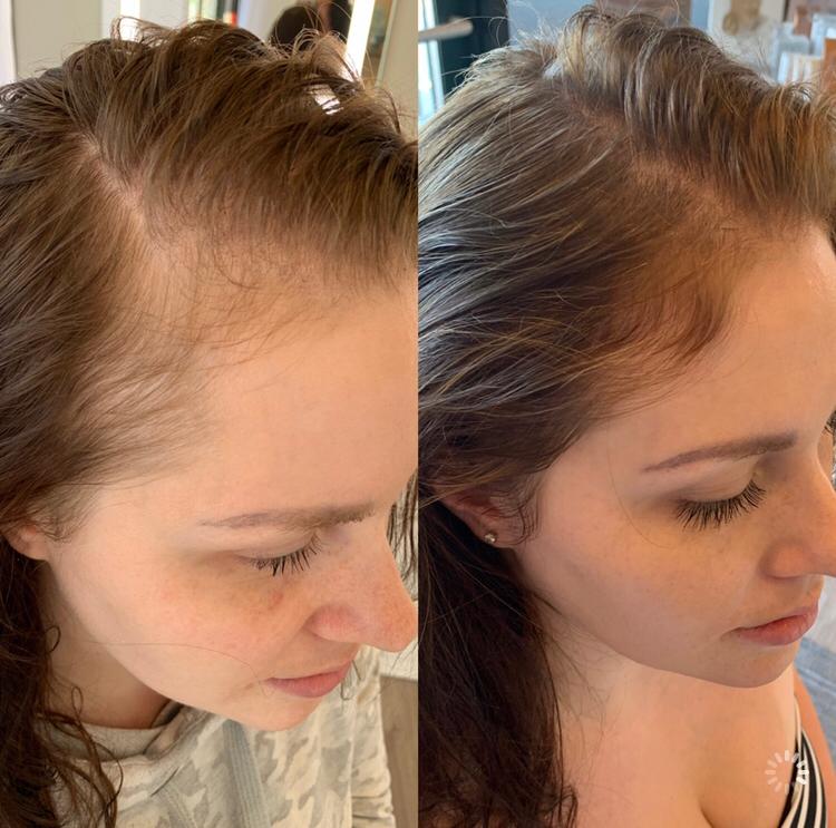 Female Hair Restoration