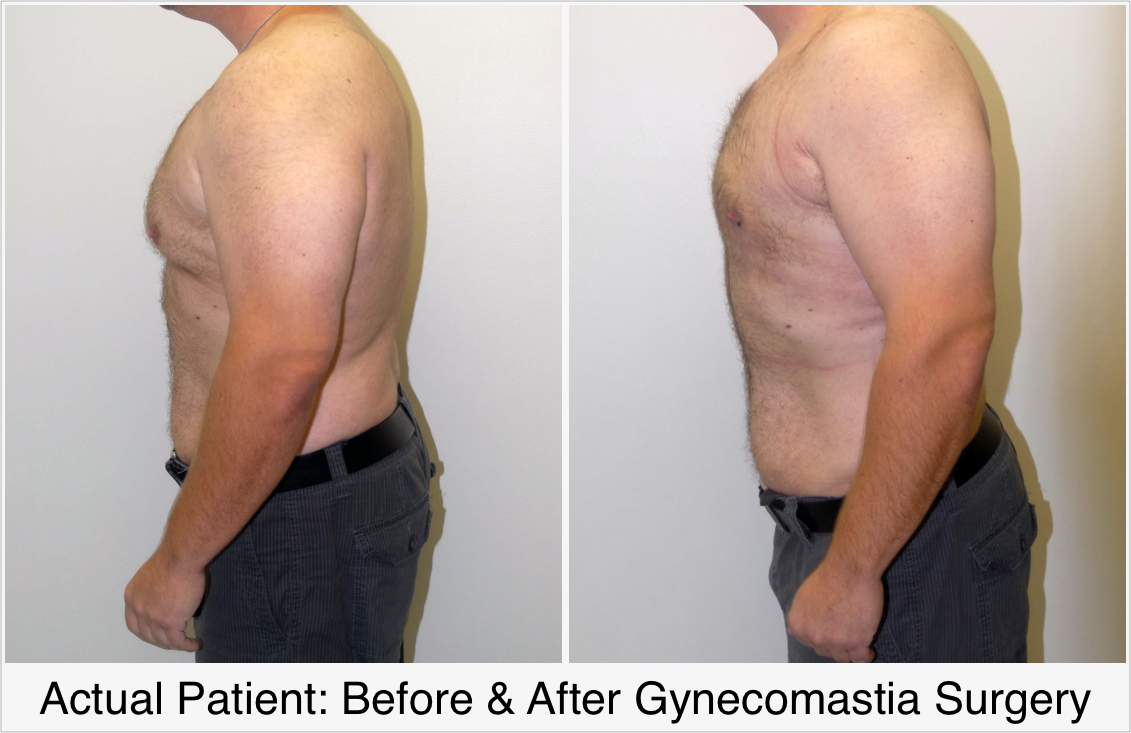 Actual Patient: Before & After Gynecomastia Surgery