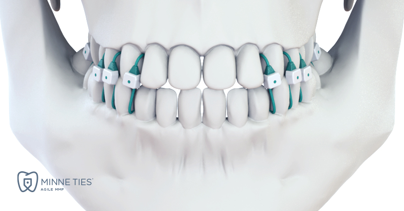 Unlike other MMF methods, Minne Ties is non-invasive and eliminates sharp wires and screws that can injure surgeons and damage patients’ gums, tooth roots and mouth.