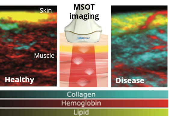 In MSOT imaging, pulsed laser light is absorbed by tissue molecules and converted to acoustic waves. Spectroscopic analysis allows to quantify collagen content which is a disease biomarker in DMD.