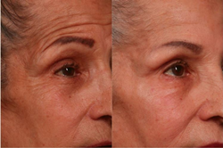 Dr. Rubinstein real patient results microtox