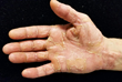 Hand eczema and irritation from excessive hand washing.