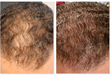 Before and after photos after treatments with PRP.