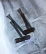 X-Ray showing InCore TMT in both 2nd and 3rd tarsometatarsal Joints (Image provided by Nicholas Dodson, DPM)