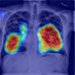 RADLogics chest X-ray heatmap