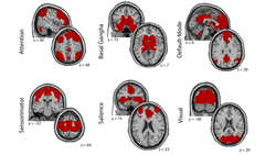 Cereset Research shares functional MRI brain maps of brain functional connectivity laterality in military-related traumatic and post-traumatic stress