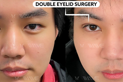 Before and After Photo of a person who had a double eyelid procedure.