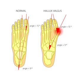 Prime Foot & Ankle Specialists are offering minimally invasive bunion surgery in Berkley Mi & Royal Oak Mi Locations